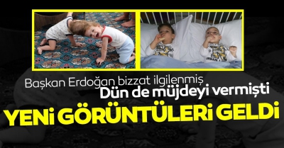 Başkan Erdoğan'ın bizzat ilgilendiği siyam ikizleri yarın geliyor;.